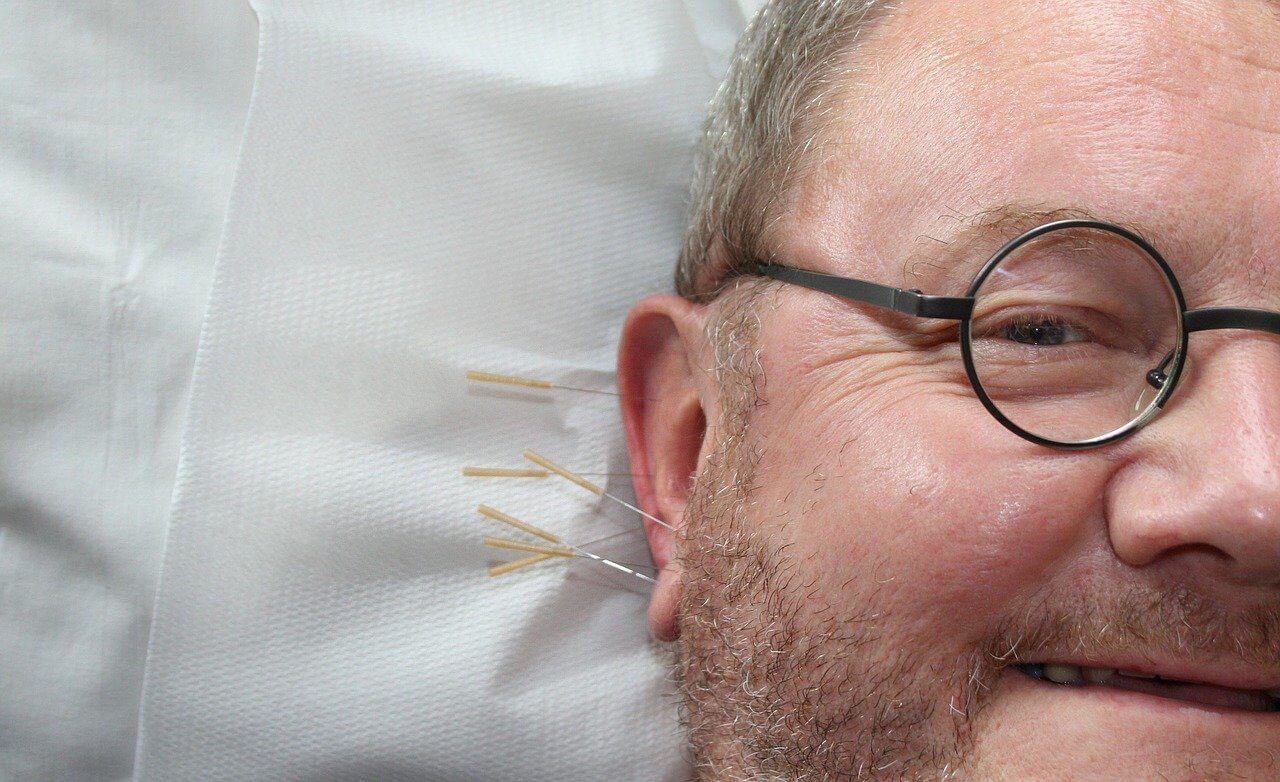 acupuncture-gcdc7b1e75_1280 (1).jpg